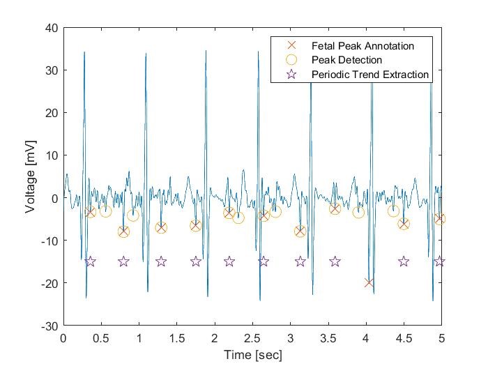 This figure depicts the periodic rhythm of the fetus’s heartbeat. UCI researchers extract the fetal heart rate by analyzing this and finding reference points. Daniel Jilani. 