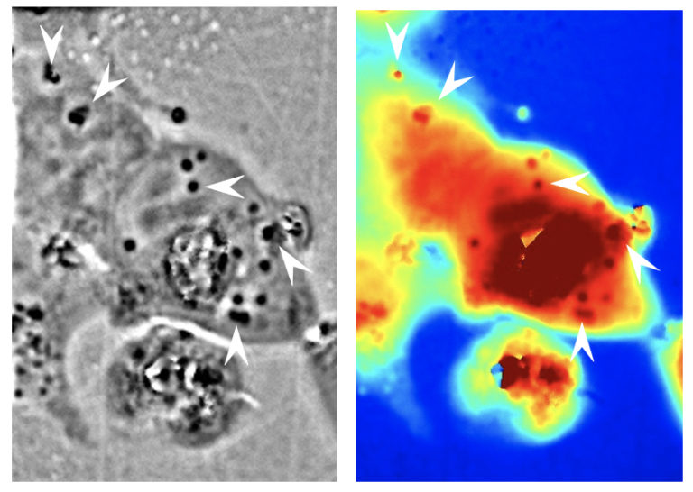 The black and white phase microscope image above helped UCI researchers identify where the squid reflectin protein nanostructures were present in human cells (dark regions, with some indicated by white arrows). The panel in color shows the associated pathlength for light traveling through a given area (red corresponds to longer pathlengths and blue corresponds to shorter pathlengths). Atouli Chatterjee / UC