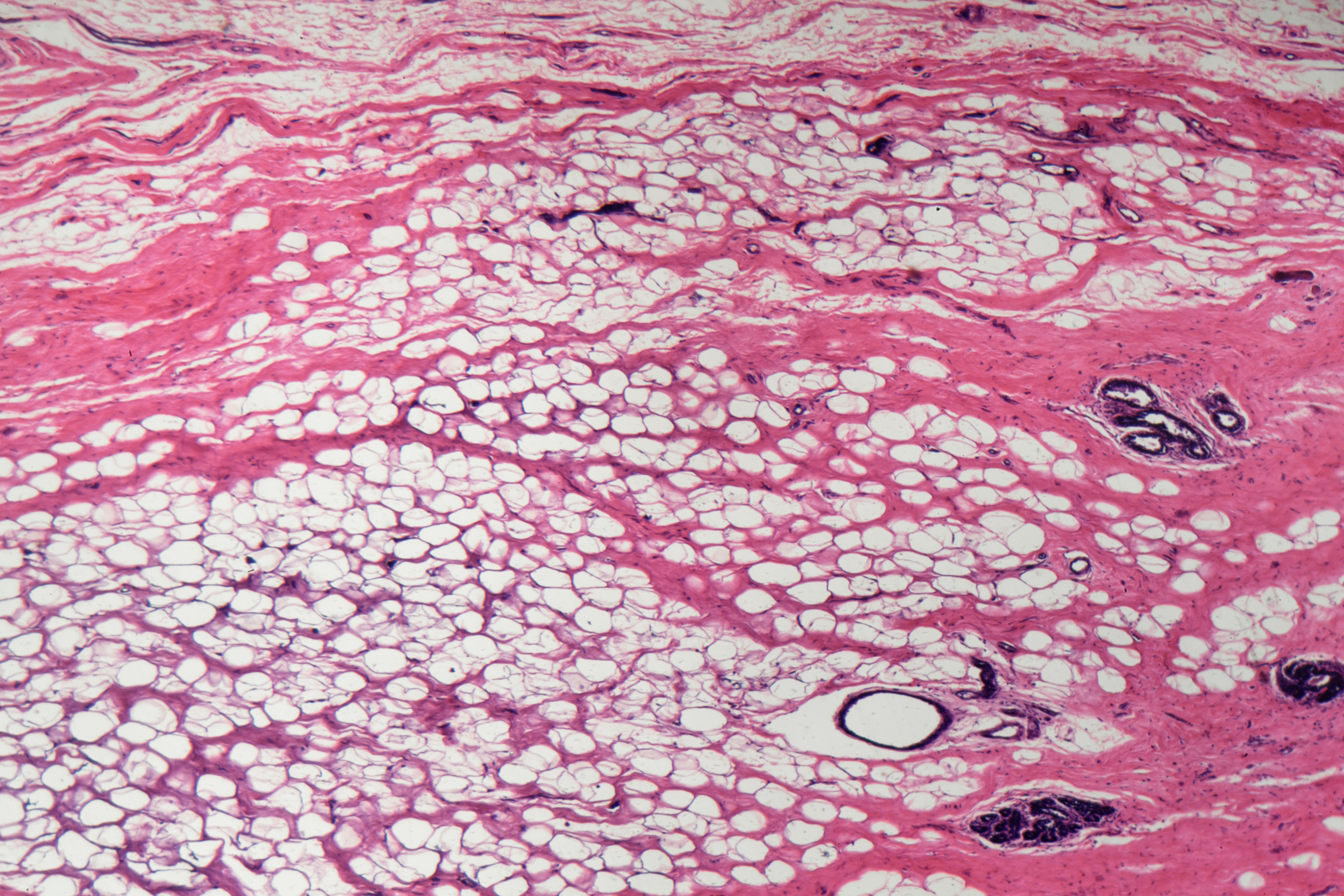 Haun evaluated the new microfluidic tissue dissociation platform on a diverse array of tissue types, such as kidney, breast (pictured), liver and heart. Single cell analysis of tissue holds the potential to change the way we search for powerful new drugs and treat patients with a more personalized approach. Haun evaluated the new microfluidic tissue dissociation platform on a diverse array of tissue types, such as kidney, breast (pictured), liver and heart. Single cell analysis of tissue holds the potential to change the way we search for powerful new drugs and treat patients with a more personalized approach.
